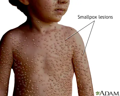 Smallpox virus